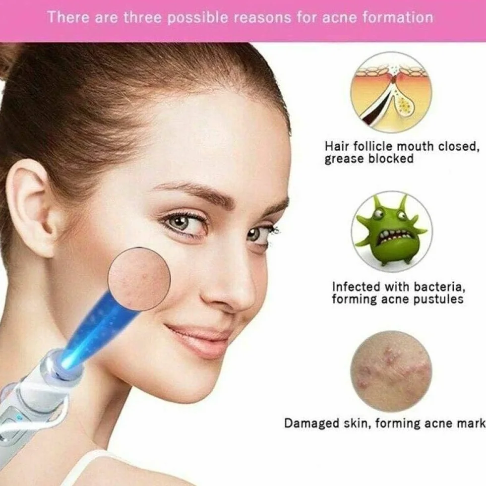 Penna Laser per Terapia a Luce Blu per vene varicose, Antirughe e Acne