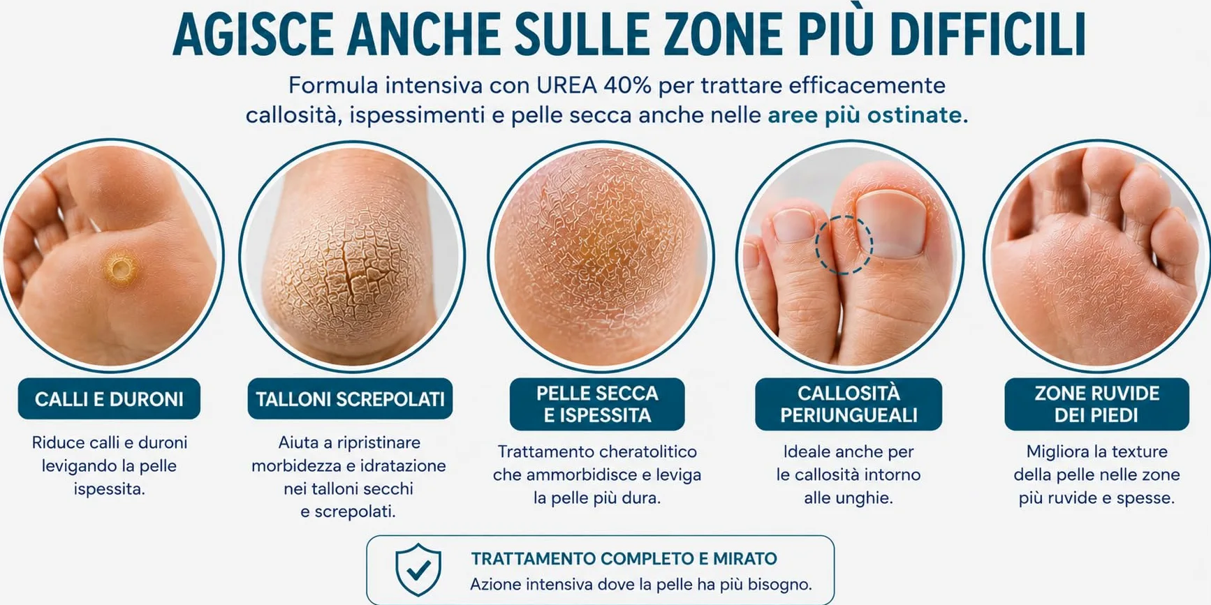 KERADERM 50 ml - Crema Piedi Urea 40% – Trattamento professionale intensivo Anti-Callosità e Talloni Screpolati – Azione Cheratolitica avanzata – Ispirato alla podologia - Made in Italy