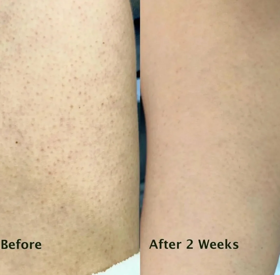 Lozione corpo per Keratosis Pilaris – elimina pelle a buccia d’arancia e ruvidità – con acido salicilico, niacinamide e zinco PCA