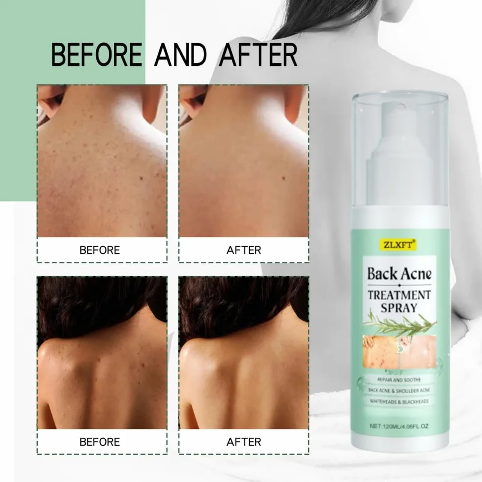 Torna Soluzione Brufolo,2pcs Spray per Brufoli Corpo,Spray per la Rimozione dei Brufoli Sulla Schiena,Post Acne Trattamento Sprays,Acnes Sprays Back And Chest,Body Acnes Sprayss