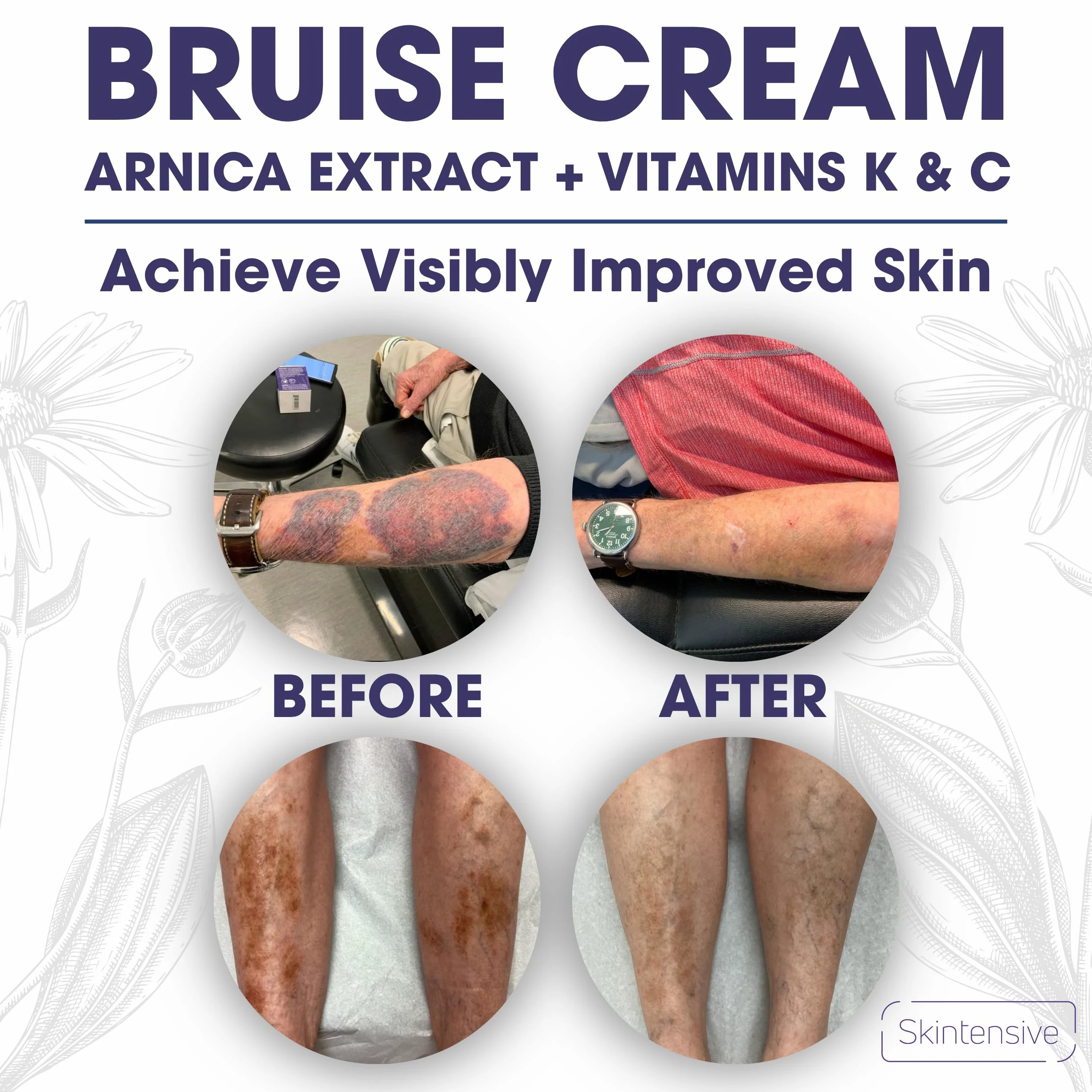 SKINTENSIVE Highest Purity Organic Arnica Plant-Based Bruise Cream for Thin Skin - Moisturizing, Anti-Aging, Healing, and Fading Scar Lotion, Vitamin K C and E, Skin Renewal