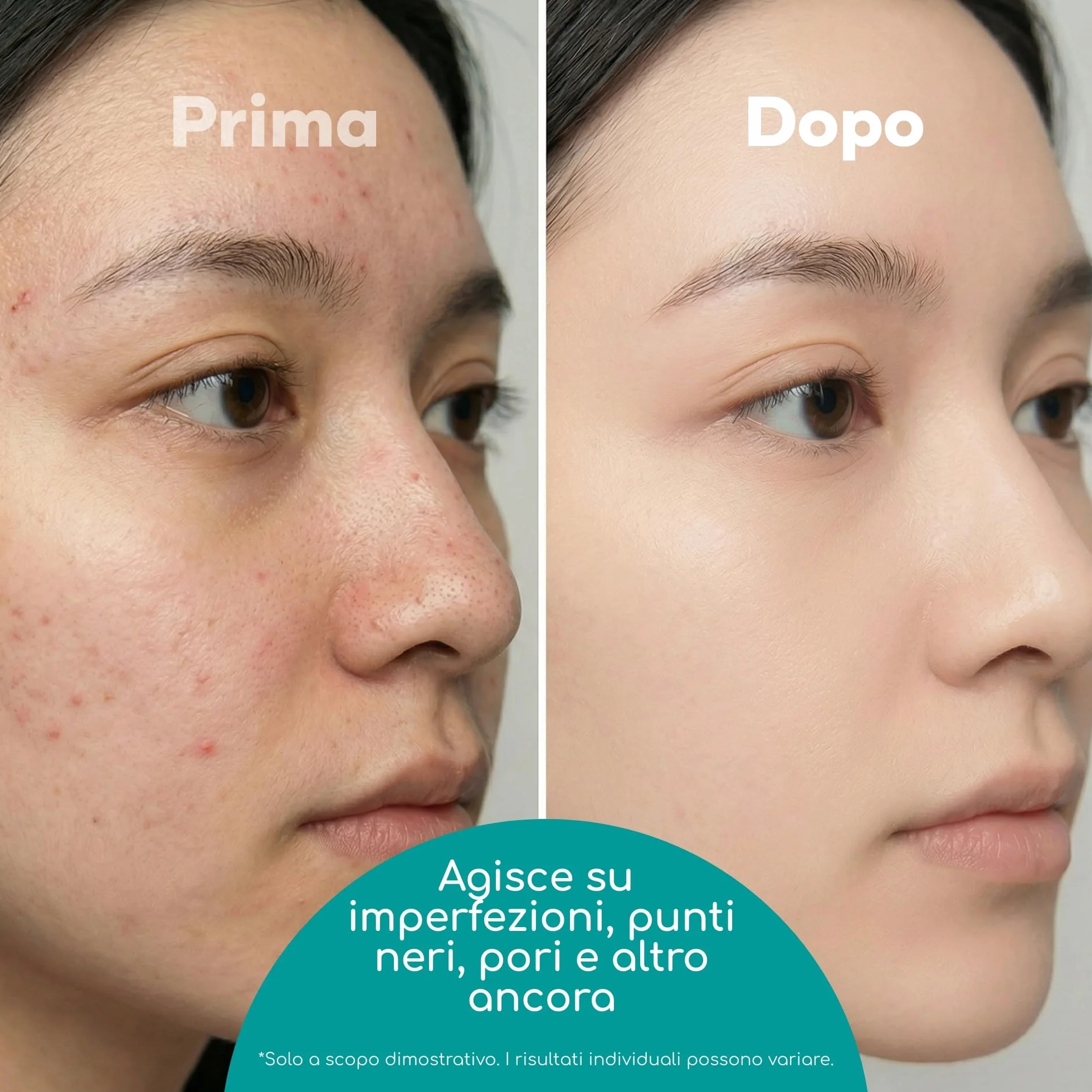 Medi Grade Kit Schiaccia Brufoli e Estrattore Punti Neri Medi Grade, Set di 7 Strumenti Togli Punti Neri