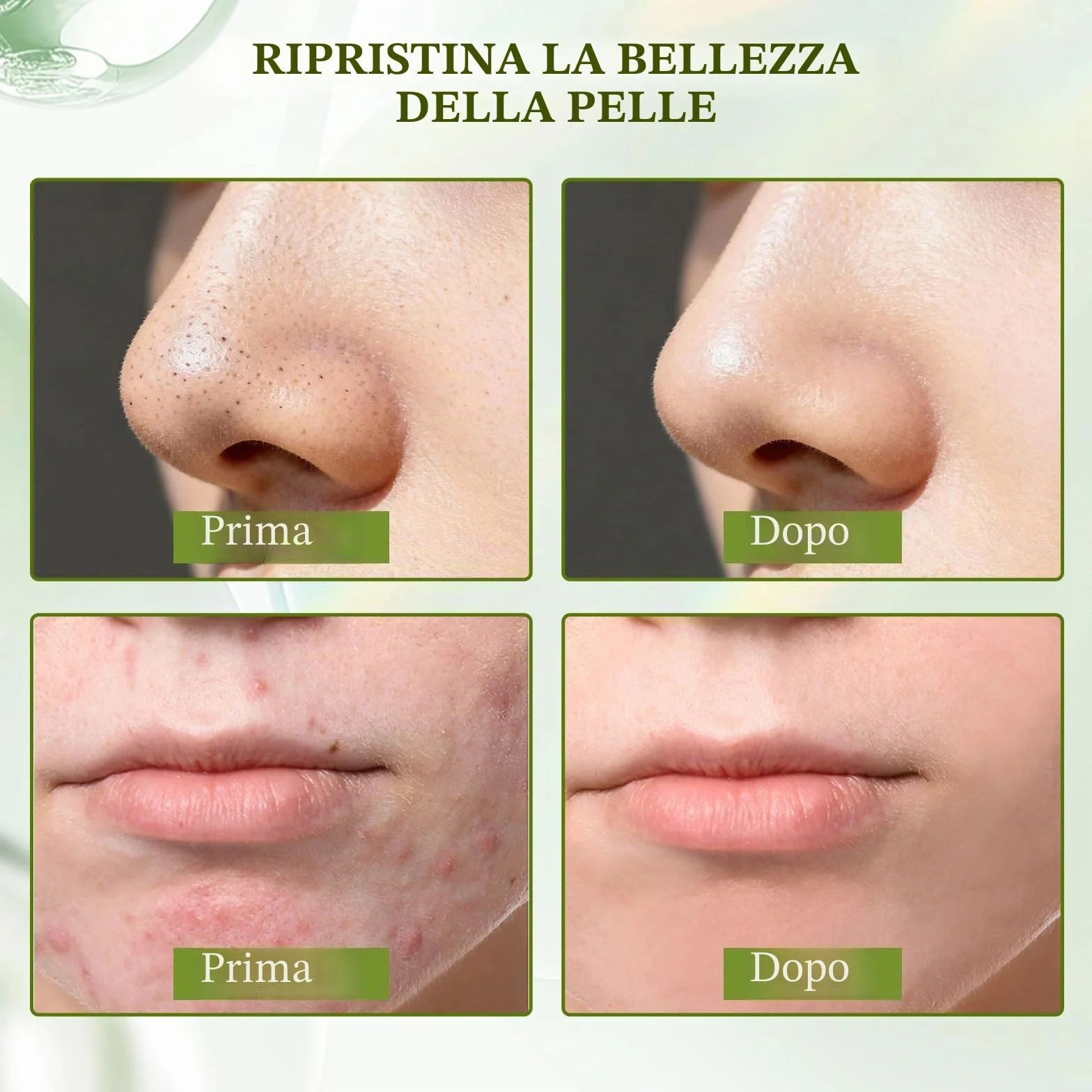 Crema Brufoli Viso, Crema Acne Potentissima, Combatte Efficacemente Acne, Brufoli e Punti Neri, Lenisce Rapidamente Gli Arrossamenti Cutanei, Adatto a Tutti i Tipi di Pelle, Ingredienti Delicati