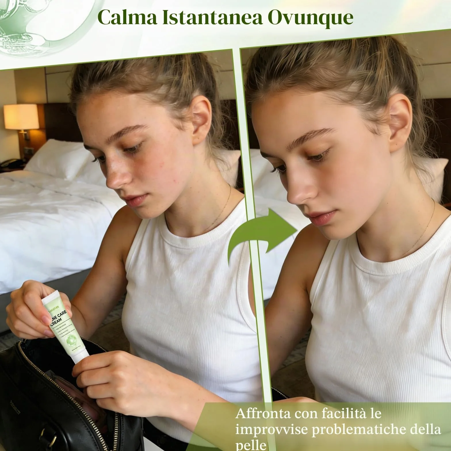 Crema Brufoli Viso, Crema Acne Potentissima, Combatte Efficacemente Acne, Brufoli e Punti Neri, Lenisce Rapidamente Gli Arrossamenti Cutanei, Adatto a Tutti i Tipi di Pelle, Ingredienti Delicati
