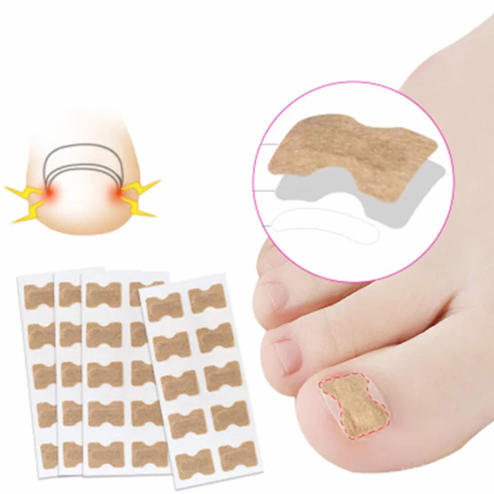 Milisten 2 Set Cerotto per La Correzione Dell'unghia Del Piede Adesivo per Raddrizzare L'unghia Del Piede Strumento di Pedicure per Il Trattamento Fisico per Gli Studenti Adulti