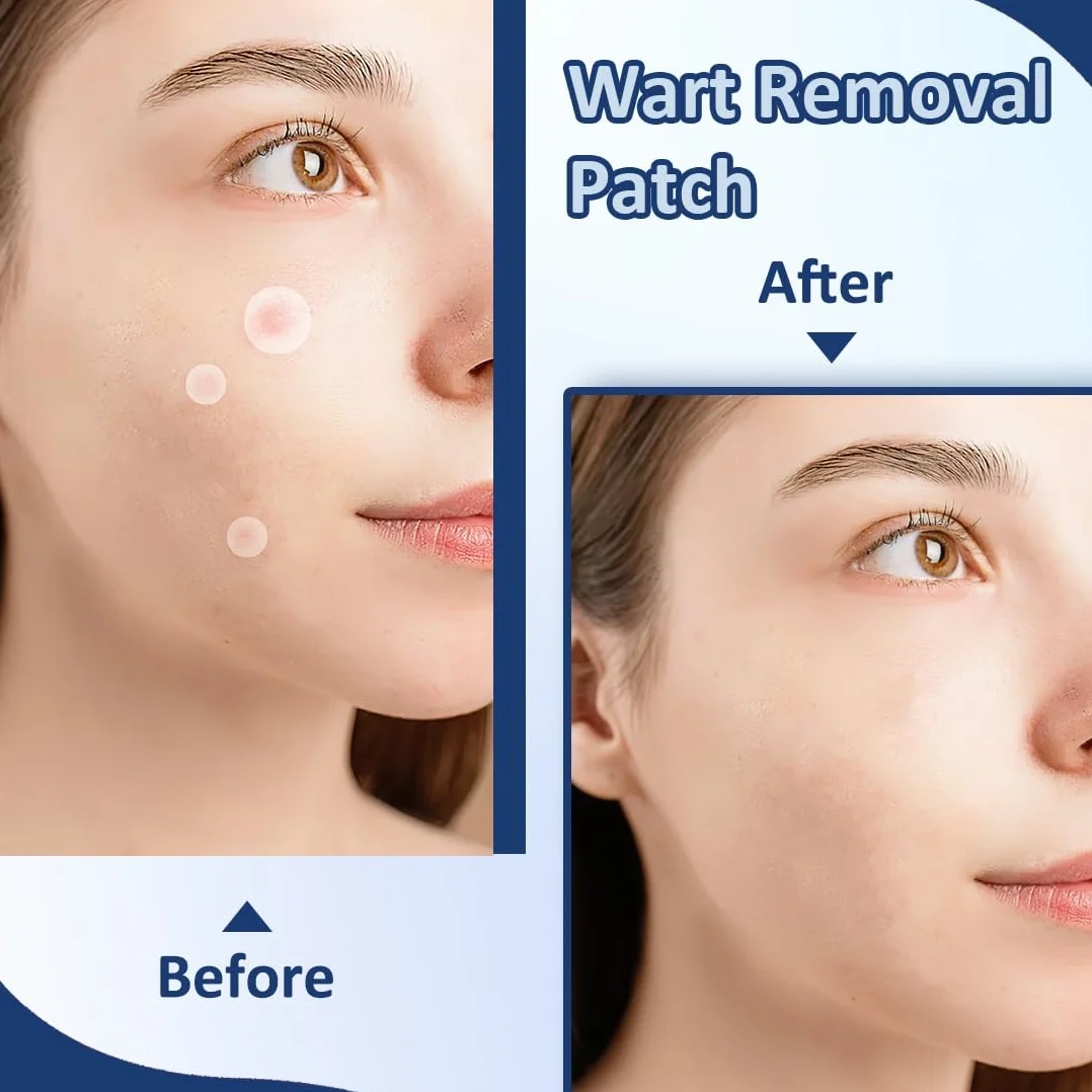 EIHI 288 cerotti per verruche, acne, formula delicata, trattamento efficace, naturale, cerotti per verruche viso e corpo, indolore, trattamento efficace