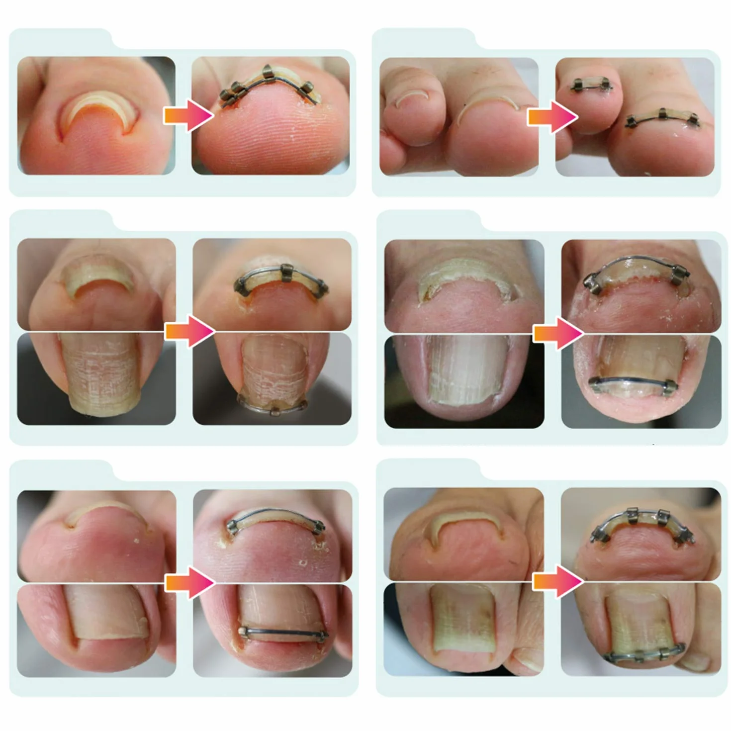 Correzione unghie per unghie incarnite | nuova innovazione | Progettato da medicina | Effetto immediato | Adatto per tutte le dimensioni delle unghie | vestibilità naturale