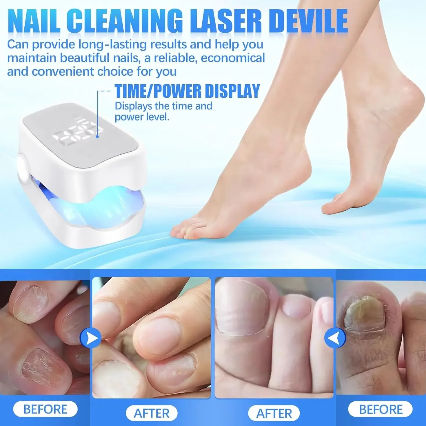 Dispositivo Laser dei Funghi Unghie Indolore,Trattamento Veloce Intensivo del Fungo dell'unghia, Luce Blu 470nm e Infrarossa 905nm per Chiodi Multipli Sicuro e Affidabile