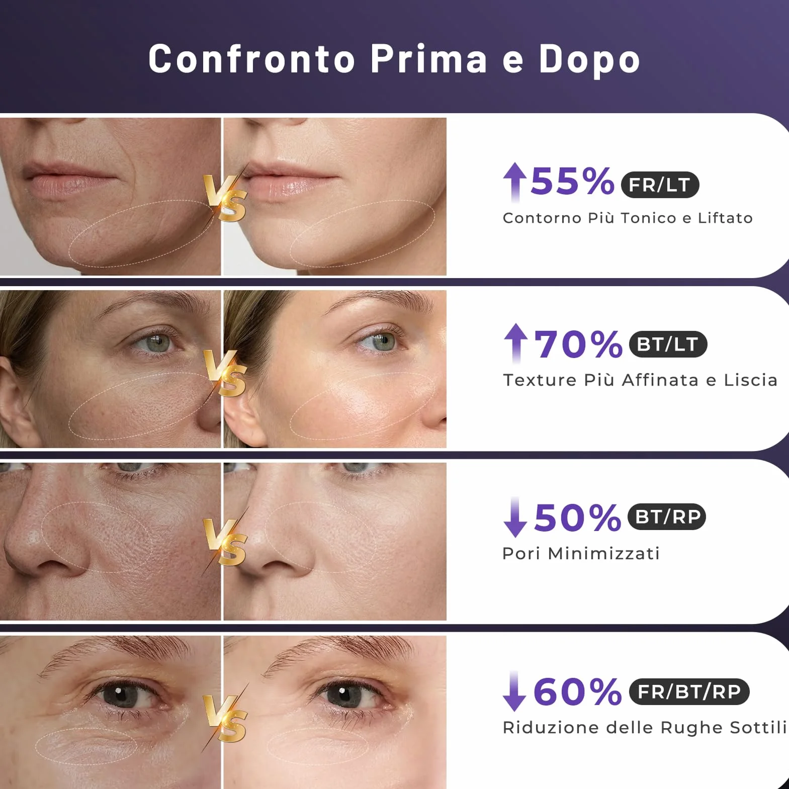 Radiofrequenza Viso Professionale, Microcorrente Massaggiatore Viso, Dispositivo Elettrico di Bellezza Antirughe, Antietà, Anti-Acne, Lifting e Rassodante per Viso e Collo (Viola)