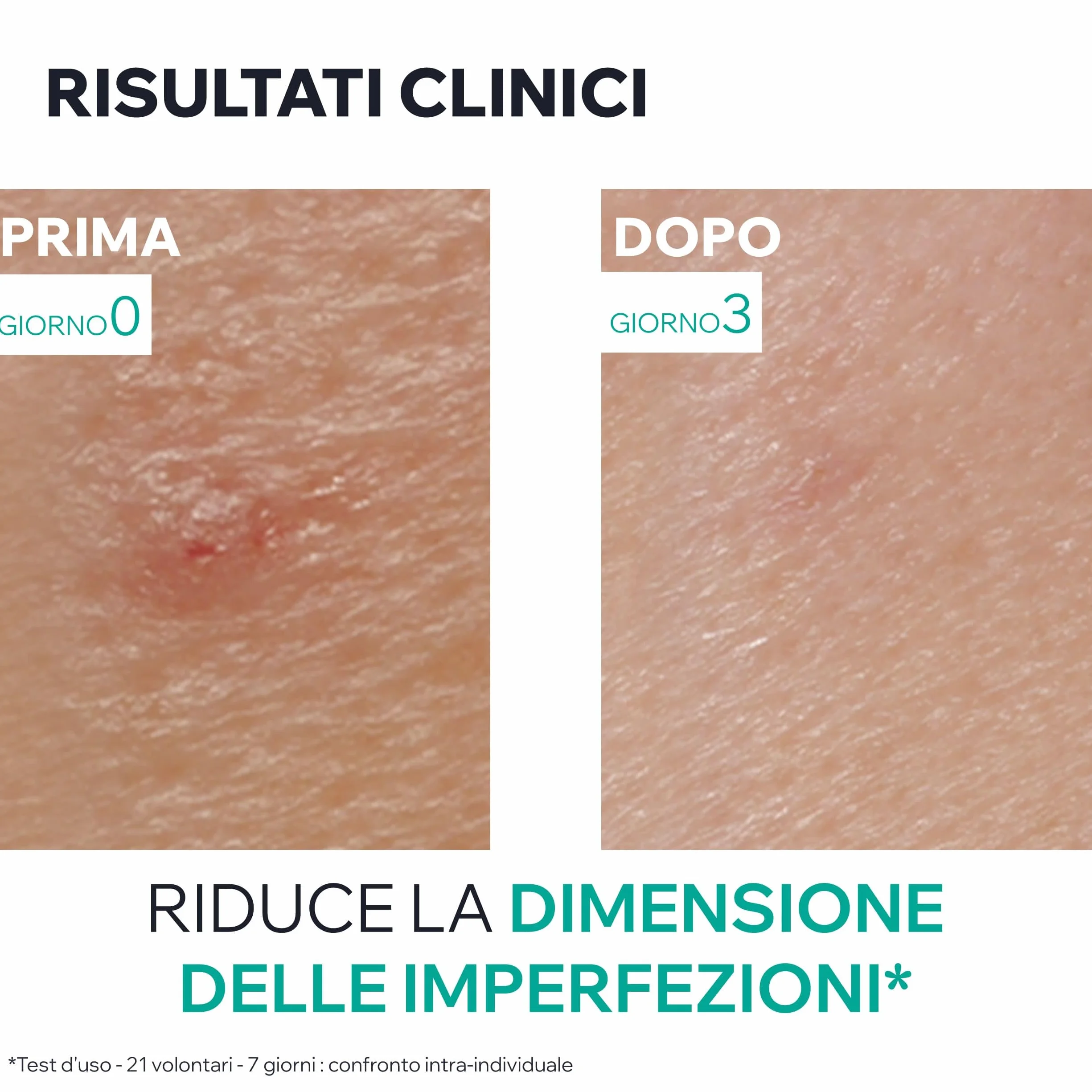 Uriage Hyseac Pasta SOS con Árbol del Té, Zinc y Arcilla Verde - Acelera la Maduración de las Imperfecciones de la Noche a la Mañana y Limita las Marcas en la Piel - Para Granos e imperfecciones.