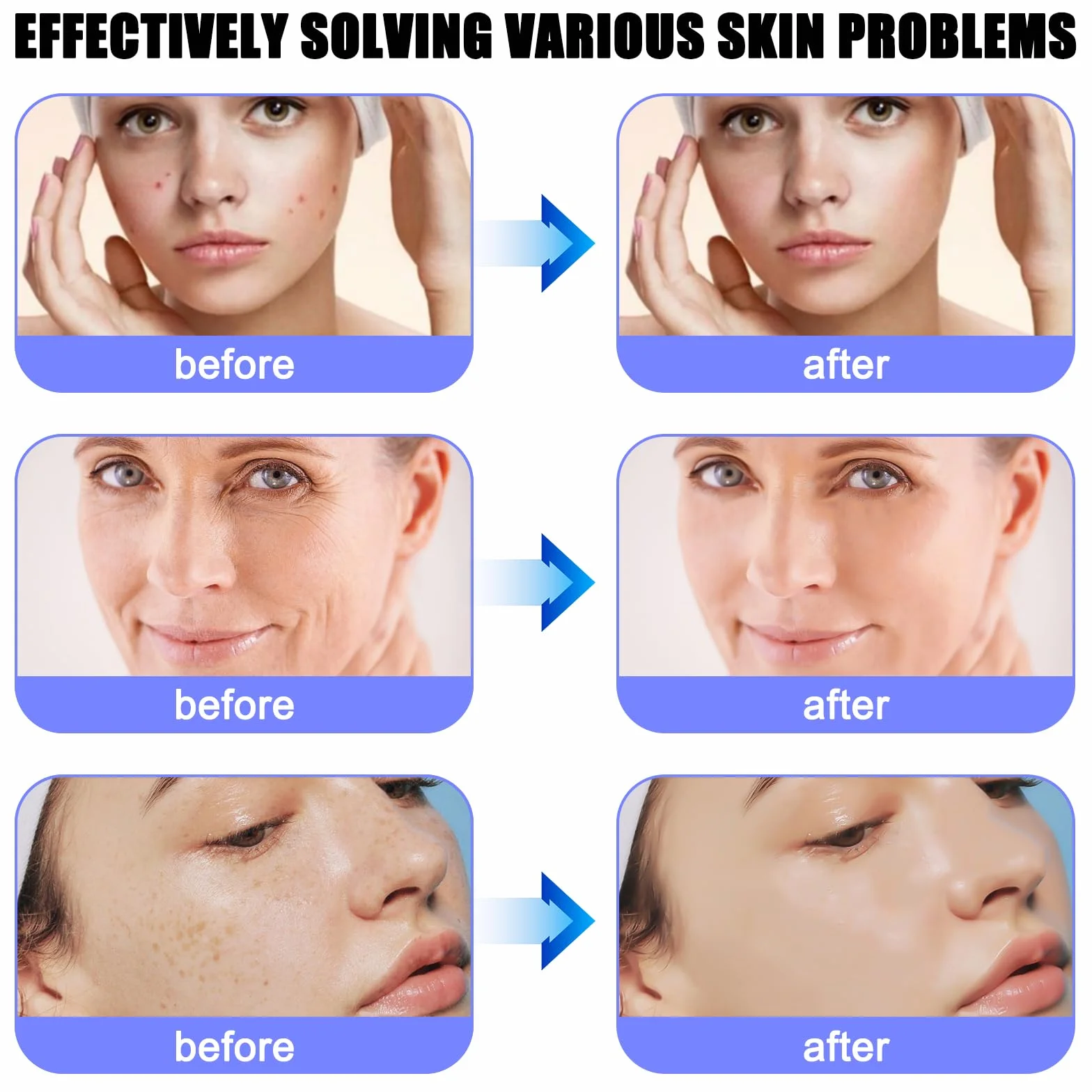 Vaileal 30 pezzi Microneedling: 12 pin Aghi di ricambio Derma Pen Micronago, Micro Electric Dermapen per la rimozione del dispositivo di acne, cicatrici e pieghe