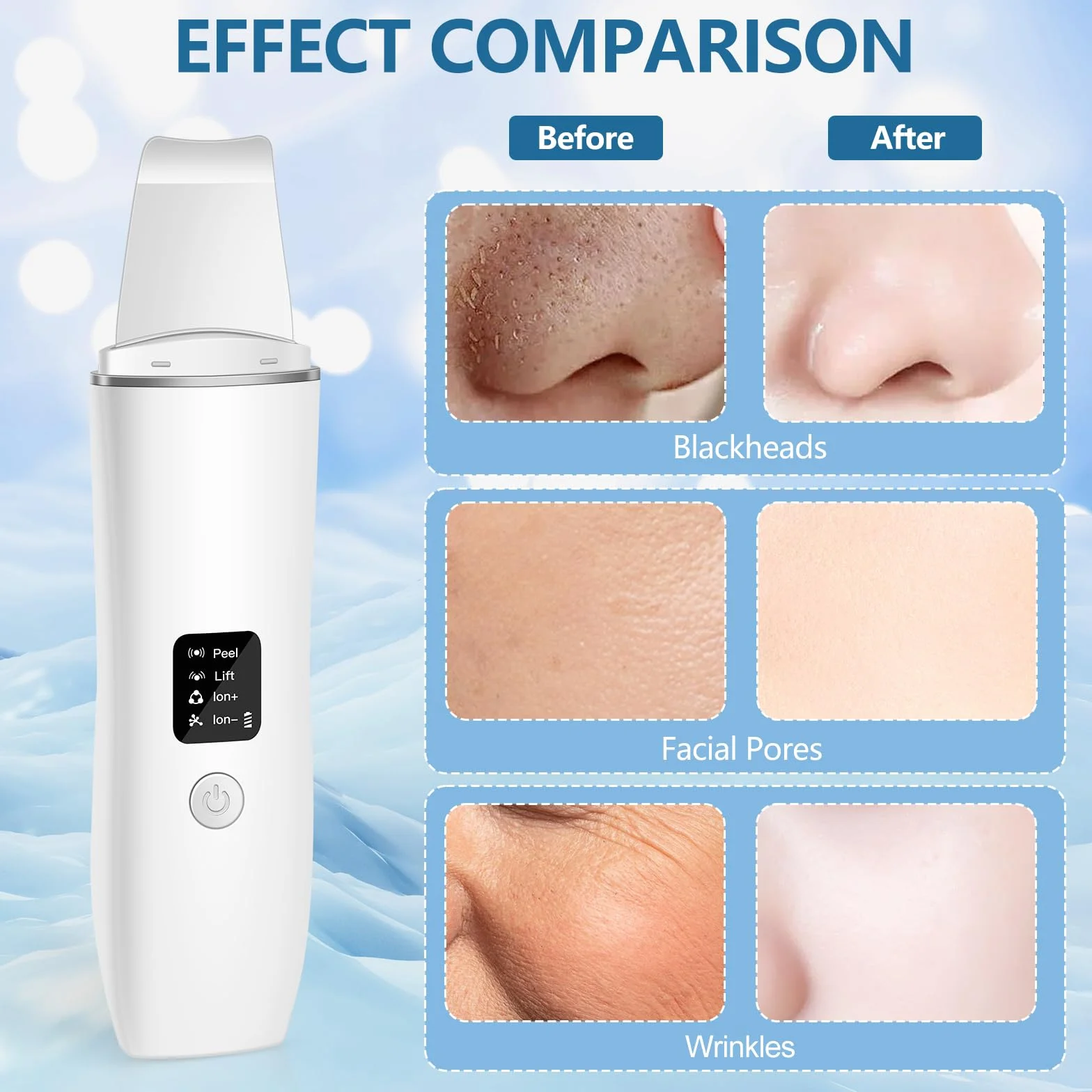 ACWOO Pulizia Viso Ultrasuoni, Skin Scrubber Professionale, Spatola Ultrasuoni Pulizia Viso con 4 Modalità Regolabili, per la Pelle per Pulizia Profonda la Viso Peeling e Rimozione e Punti Neri