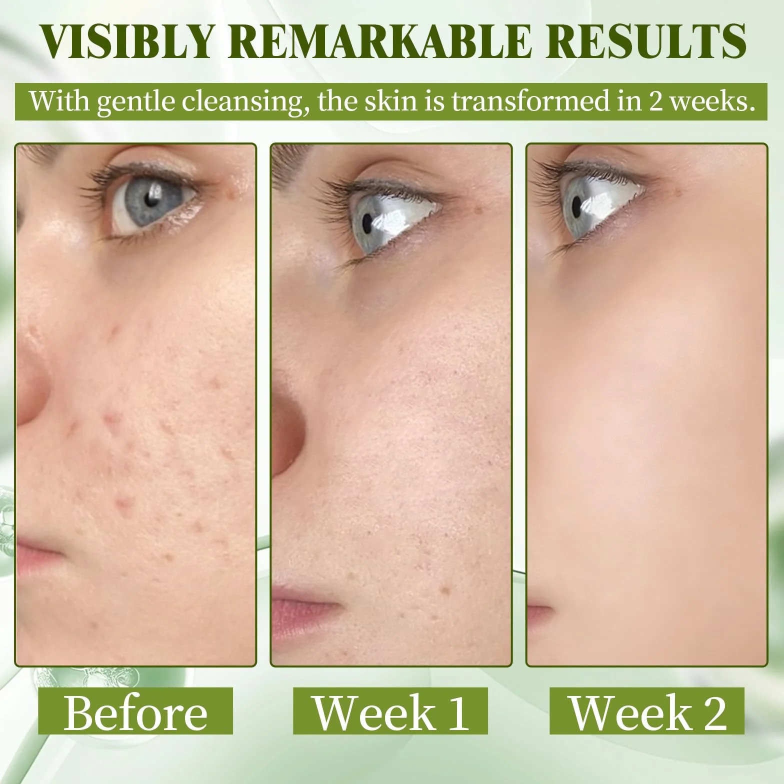 Crema Brufoli Viso, Crema Acne Potentissima, Combatte Efficacemente Acne, Brufoli e Punti Neri, Lenisce Rapidamente Gli Arrossamenti Cutanei, Adatto a Tutti i Tipi di Pelle, Ingredienti Delicati