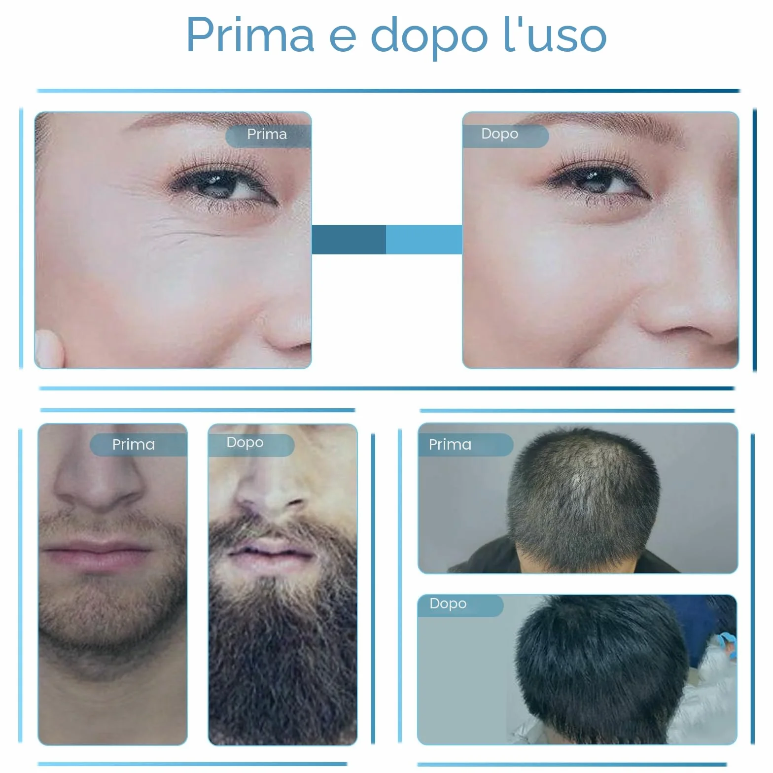 Derma Stamp, Dermastamp Regolabile 0-3 mm, Derma Roller Capelli, 140 Perni, Timbro Professionale Microneedling Stamp per Stimolare la Crescita di Capelli, Barba, Viso