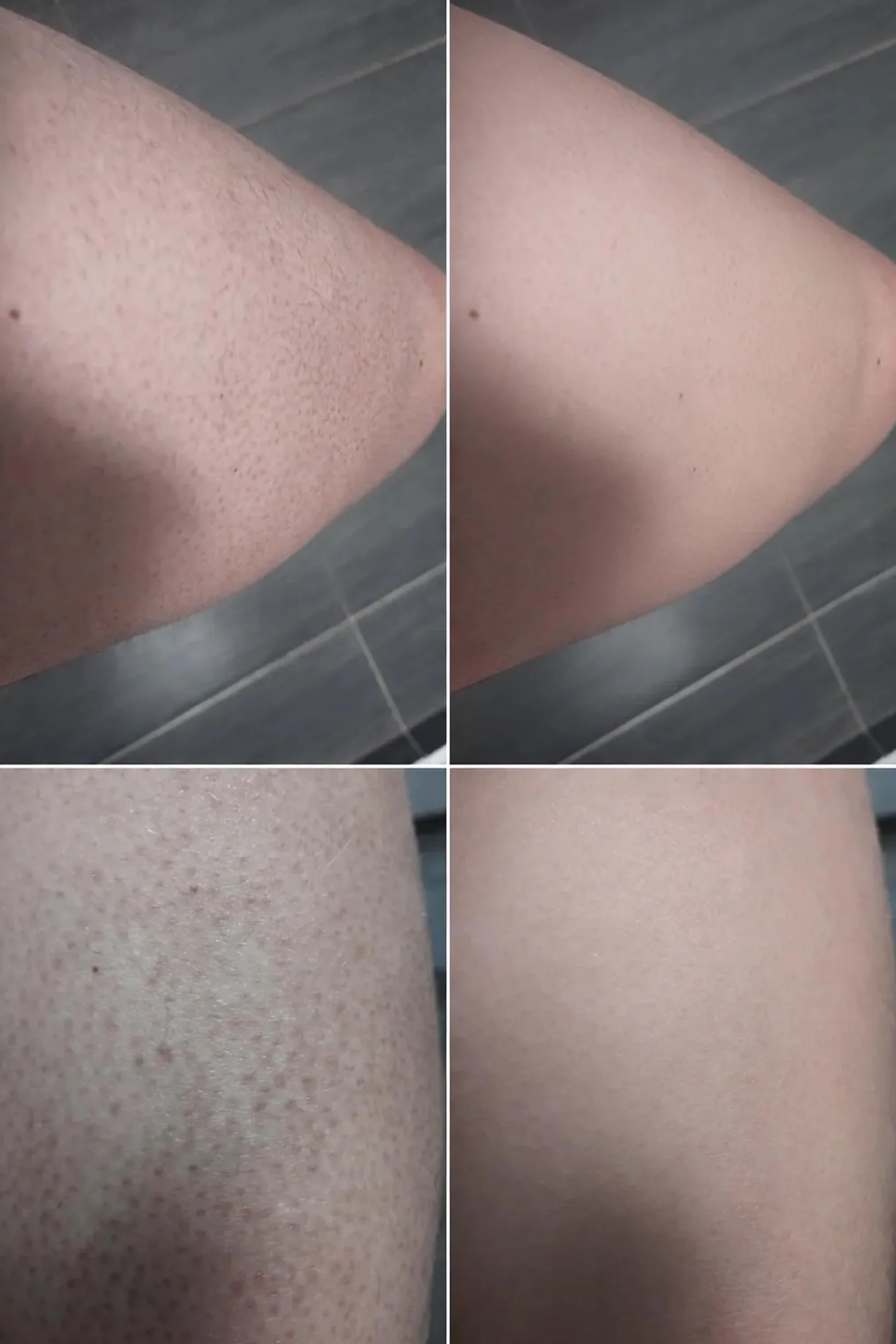 Lozione corpo per Keratosis Pilaris – elimina pelle a buccia d’arancia e ruvidità – con acido salicilico, niacinamide e zinco PCA