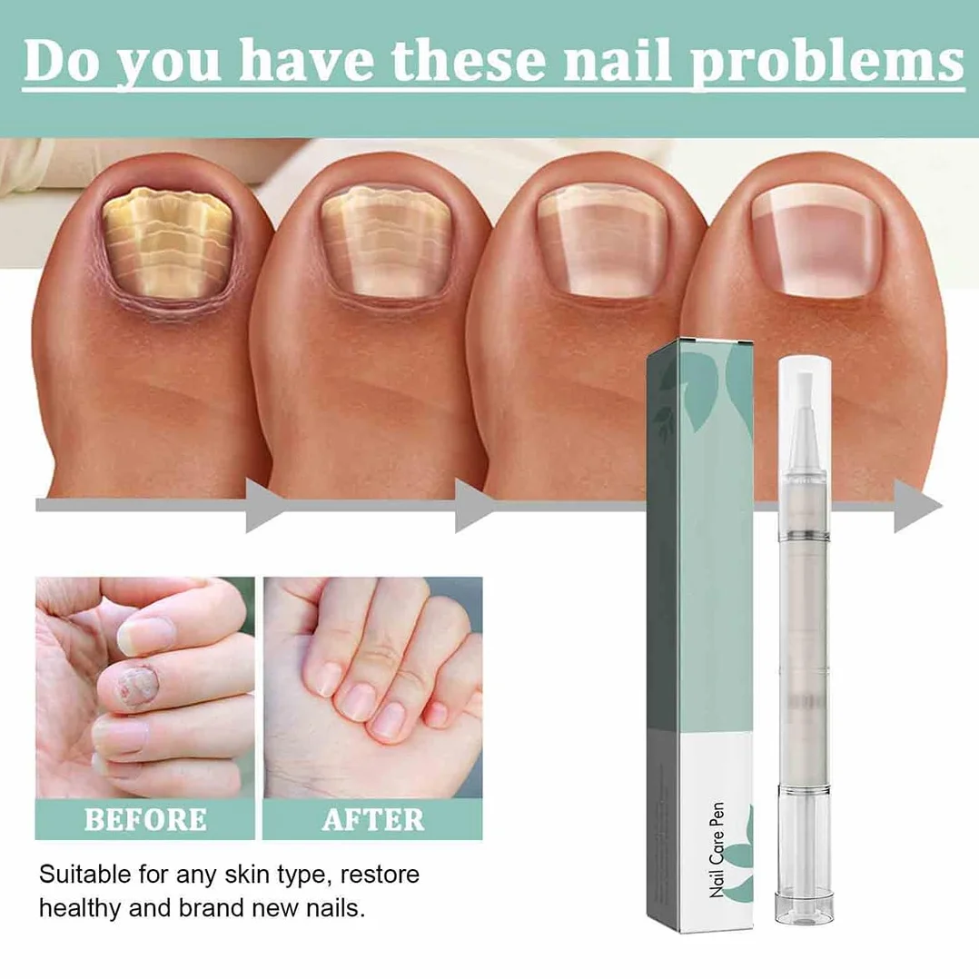 3 pezzi Penna per la Cura Delle Unghie, nail care pen fungo del chiodo, Pennas per Cuticole Unghie Nail Treatment Pen Con Aloe Vera e Olio Dell'albero,Per Cura Delle Unghie e Delle Cuticole