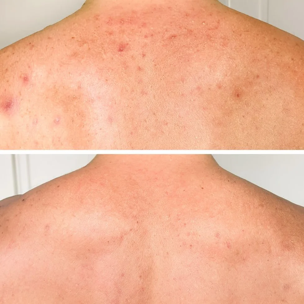 Lozione corpo con acido salicilico (200 ml) – per imperfezioni, pelle secca e grassa. Con BHA, niacinamide e acido ialuronico per esfoliare e idratare